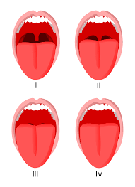 Pal·a·to·glos·sal arch ta one of a pair of ridges or folds of mucous membrane passing from the soft palate to the side of the tongue; Mallampati Score Wikipedia