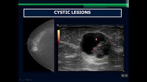 Pin On Breast Imaging