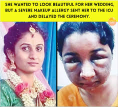 In a shocking incident from Hassan District, Karnataka, a young bride's  wedding took a heartbreaking turn when she suffered a severe allergic  reaction to a cosmetic product used during her bridal makeup.