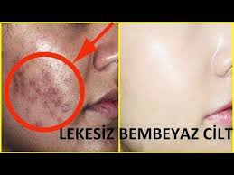 Lekesiz Bembeyaz Cilt Icin Leke Giderici Yuz Beyazlatici Karbonat Maskesi Guzellik Bakim Youtube Karbonat Yuzler Cilt Bakimi