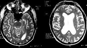 The laboratory diagnosis of autoimmune encephalitis. Atypical Herpes Type 2 Encephalitis Associated With Normal Mri Imaging Journal Of Neurology Neurosurgery Psychiatry