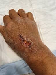 Image result for große winkelspinne biss haut reaktion