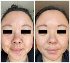 Best anti aging products for 30s. Tretinoin Before And After Photos How Do You Know It Will Work For Your Skin Dear Brightly