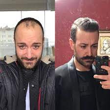 Before After Hair Transplantation Sac Ekimi Oncesi Ve Sonrasi Sacekimi Sacekimiuzmani Sacekimmerk Hair Loss Solutions Hair Transplant Best Hair Transplant