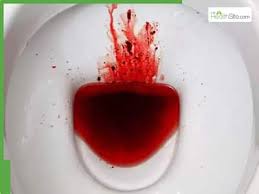 Image result for Blood in stool