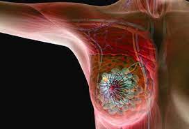 But if you've been diagnosed with breast cancer before menopause, some of your treatments could bring on menopause more quickly and more abruptly than you expected. Breast Cancer Early Warning Signs Symptoms Causes Types Risk