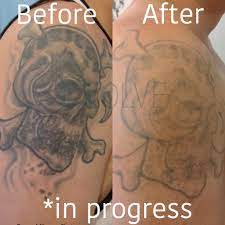 We did not find results for: Evolve Tattoo Removal Facebook