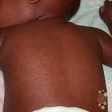 Image result for Measles