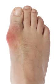 Image result for gout symptoms toe