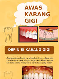 Karang gigi terbentuk akibat mineralisasi plak gigi, ketahui gejala, penyebab, jenis, cara pengobatan, dan pencegahan karang gigi. Karang Gigi