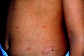 The cause of pityriasis rosea is unknown and there is no cure to date. Pityriasis Rosea