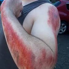 110 Road Rash Ideas In 2021 Road Rash Rashes Road Rash Treatment