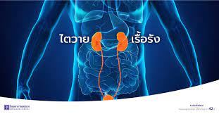 ภาวะไตวายเรื้อรัง เป็นภาวะที่ไตค่อยๆ สูญเสียความสามารถในการทำงานลง ซึ่งสาเหตุหลักๆ ได้แก่. à¹„à¸•à¸§à¸²à¸¢à¹€à¸£ à¸­à¸£ à¸‡ à¸„à¸§à¸²à¸¡à¹€à¸ª à¸¢à¸‡à¸— à¸„à¸™à¸Šà¸­à¸šà¸ à¸™à¹€à¸„ à¸¡à¸„à¸§à¸£à¸£à¸°à¸§ à¸‡
