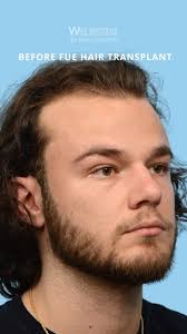 One of the lesser-known functions of the FUE hair transplant is to conceal  scars., This method works so well because we’re placing hair follicles  individually, which allows us to precisely fill in and ...