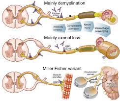 Guillain Barre Syndrome Mayo Clinic Proceedings