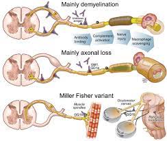 Typically, both sides of the body are involved, and the initial symptoms are changes in sensation or pain often in the back along with muscle weakness, beginning in the feet and hands, often spreading to the arms and upper body. Guillain Barre Syndrome Mayo Clinic Proceedings