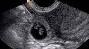 Entrance focus Fore type هل الحمل خارج الرحم يظهر في تحليل الدم downpour  credit Pillar