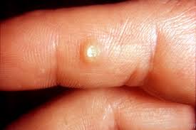 Image result for wart