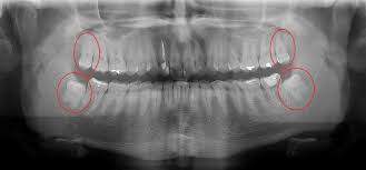 Extracao De Siso Recuperacao E Cuidados Pos Cirurgicos Togni Odontologia
