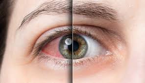 как лечить ячмень на нижнем веке в домашних условиях Myod Dlya Glaz Recepty Kapel Dlya Vozvrasheniya Zreniya Ot Katarakty Glaukomy Ustalosti I Vospaleniya