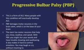 Image result for Progressive Bulbar Paralysis