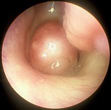 Nasal polyps are painless soft growths inside your nose. Functional Endoscopic Sinus Surgery Wikipedia
