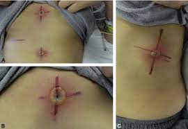 The tattoos are necessary to make it possible for you to bathe or shower on a daily basis without worrying about removing these important marks that show where the radiation treatments are to be delivered. A Infected Radiation Tattoos On Chest Abdomen Distant B Download Scientific Diagram
