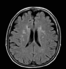 Periventricular White Matter Lesions
