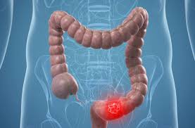 It usually begins as signs and symptoms of colon cancer include: Colon Cancer Symptoms That Are Easily Overlooked U S News