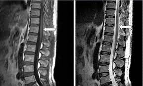 Spinal Epidural Hematoma Core Em