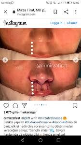Pin By Irena Martic On Estetik Nose Job Plastic Surgery Rhinoplasty