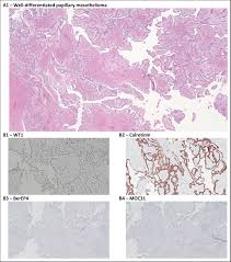 The current definition of biphasic mesothelioma requires that ≥10% of both epithelioid and sarcomatoid components be present. Well Differentiated Papillary Mesothelioma With Two Synchronous Serous Gynaecologic Carcinomas In A 62 Year Old Woman Lessons Learned For The Gynaecologic Surgeon Journal Of Obstetrics And Gynaecology Canada