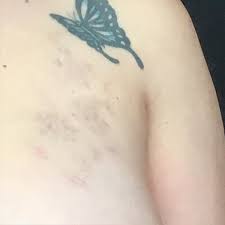 Danielle is an extremely nice woman and has made. Laser Tattoo Removal Before And After 05 Montilla Plastic Surgery