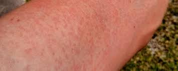 If you are also using sunscreen, apply sunscreen first and insect repellent second. Zika Virus Newly Arrived Flavivirus May Be Behind The Increase In Microcephaly Cases In Brazil Science In The News