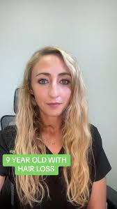 Early Signs of Alopecia in Children