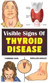 The First Visible Symptoms Of Thyroid Disease In 2020 Thyroid Disease Symptoms Thyroid Disease Thyroid Disorders