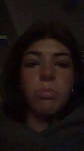 Swollen Eyelids Mono