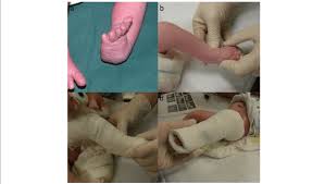 Is that deformity is the state of being deformed while clubfoot is (medicine) a congenital deformity of the foot in which the ankle, heel. A Clubfoot Deformity With Adduction Equines And Supination The Cavus Download Scientific Diagram