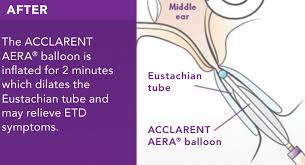 Image result for Eustachian Tube Dysfunction