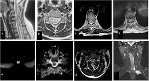 Krankheitsschübe wie auch läsionen in der magnetresonanztomographie (mrt) reflektieren den krankheitsprozess bei der… teriflunomid reduziert den jährlichen verlust an hirnvolumen frankfurt, 02. Spinal Cord Infarction Clinical And Radiological Features Journal Of Stroke And Cerebrovascular Diseases