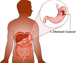 The complicating factor about this cancer is that the people aren't aware of the early symptoms and by the time they realize that the government had cancer, the tumor are likely to have spreaded all over. Stomach Cancer All You Need To Know About The Disease Kerosi Blog