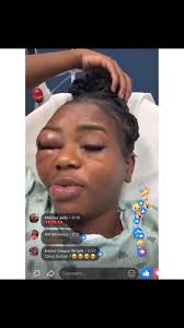 E don happen! A young lady took to social media to show her swollen eye,  which she cannot open, after being jumped by a couple-a man and a woman  👀👀🙆🙆‍♀️🙆🏻🙆🏻‍♀️