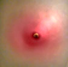 Bila da berlakunya jangkitan kuman pada luka caesarean ini, sampel (swab) akan diambil pada luka ini. Cara Nak Sembuhkan Luka Dengan Cepat Amynorami Com