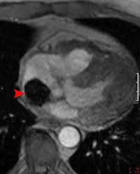 Image result for Cardiac MRI