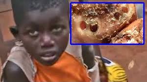 Yeah jigger holes look somewhat like this but this is the typical photoshopped image that comes up when you google trypophobia. Jigger Flea Foot