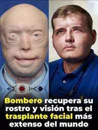 He suffered devastating burns when he tried to rescue a woman trapped in a  fire. For years, he was terrified to show his face to the world, and wore  caps, sunglasses and