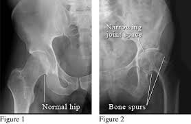 Image result for Hip XRay