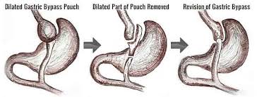 Gastric Bypass Revision Surgery Reasons Types Gastric Bypass Revision Surgery Bypass