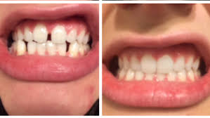 For mild underbites, you can get braces, tooth extractions, or an upper jaw expander. Invisalign Reddit Before After I Finished My Invisalign Treatment Now What