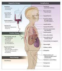 Infographic on thalassemia: supportive and curative therapies, organ illustration, and complications